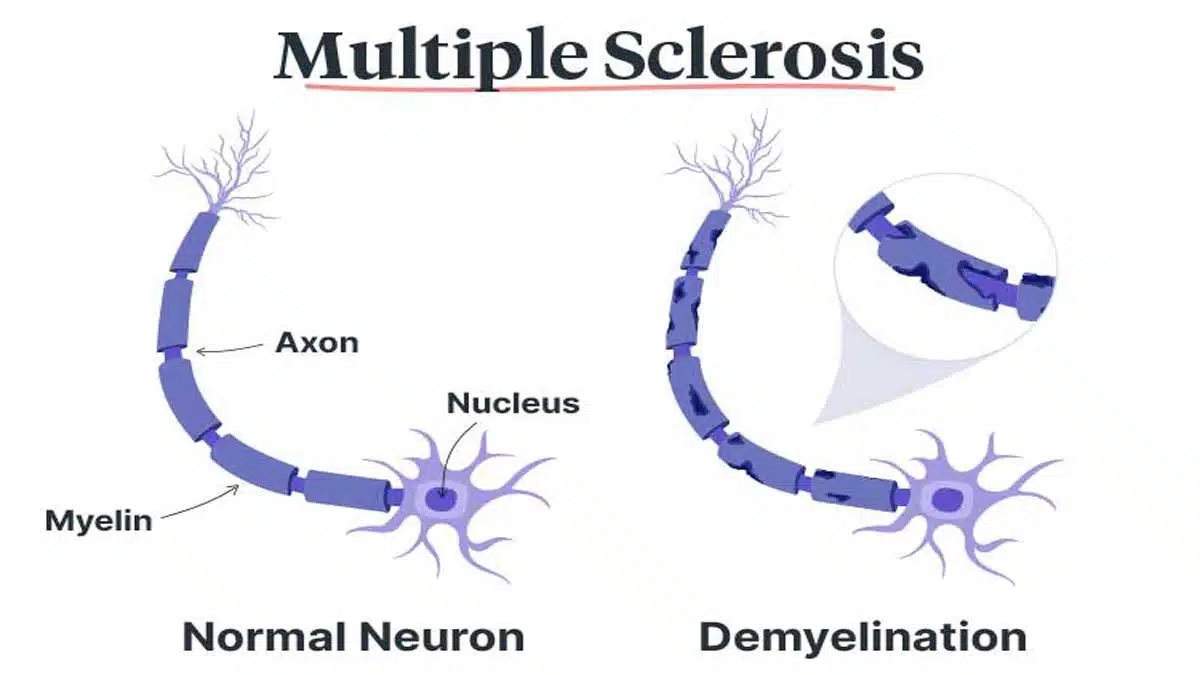 Multiple Sclerosis (MS): Causes, Symptoms