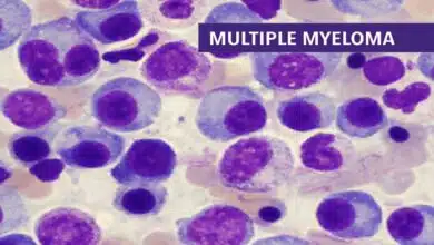 Myeloma (Multiple Myeloma) Disease