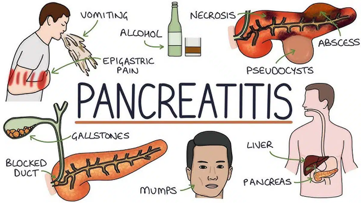 Pancreatic Disorders: Causes, Symptoms, Diagnosis