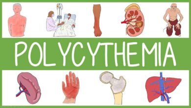 Polycythemia Vera: Causes, Symptoms