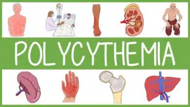 Polycythemia Vera: Causes, Symptoms