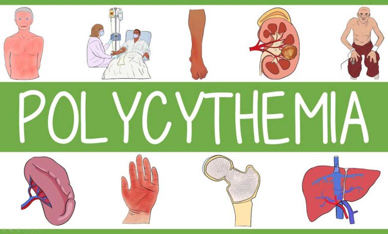 Polycythemia Vera: Causes, Symptoms