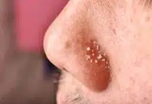 Remove blackheads and whiteheads, learn the easy way from experts!