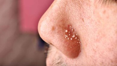Remove blackheads and whiteheads, learn the easy way from experts!