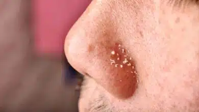 Remove blackheads and whiteheads, learn the easy way from experts!