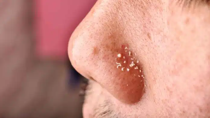 Remove blackheads and whiteheads, learn the easy way from experts!