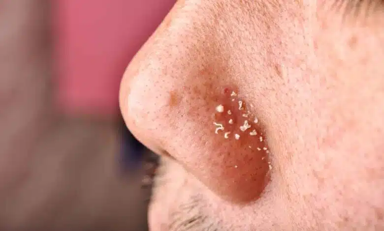 Remove blackheads and whiteheads, learn the easy way from experts!