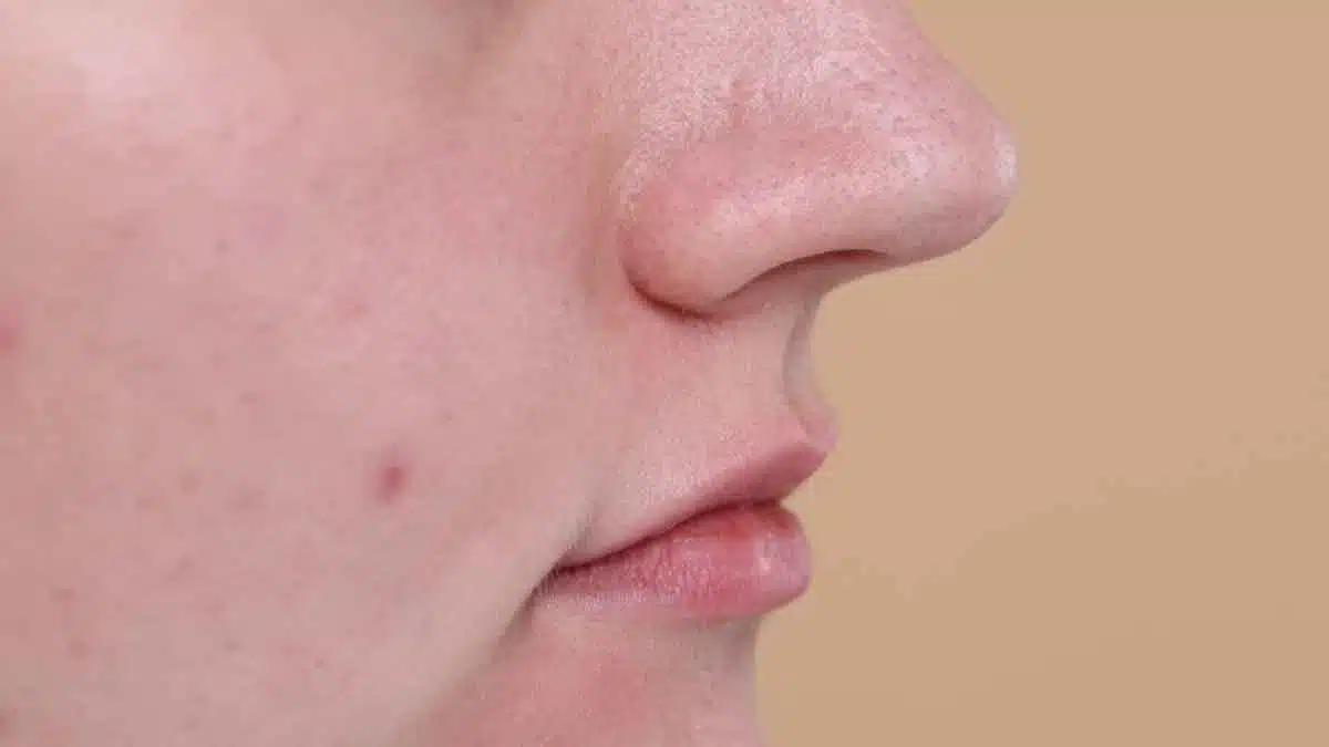 Remove blackheads and whiteheads, learn the easy way from experts!