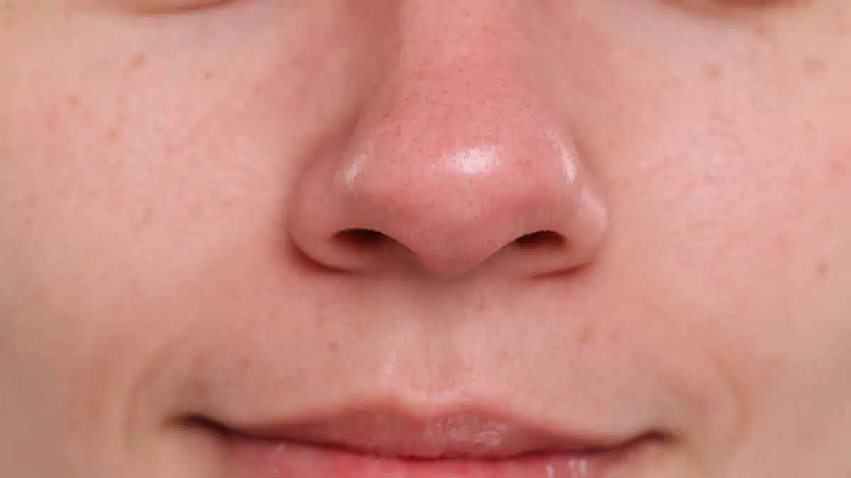 Remove blackheads and whiteheads, learn the easy way from experts!