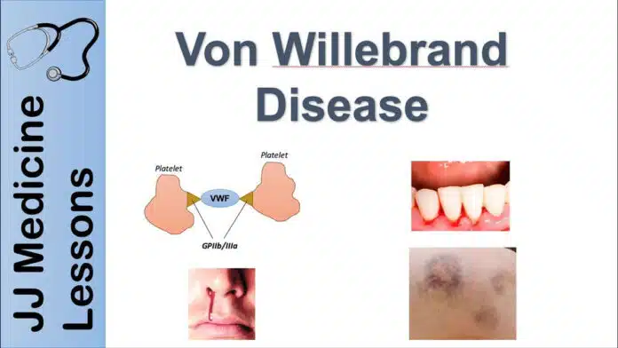 Von Willebrand Disease: Causes, Symptoms