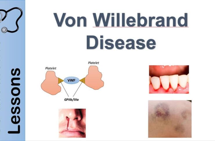 Von Willebrand Disease: Causes, Symptoms