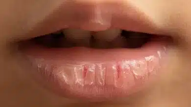 Why do lips crack in summer Know 5 reasons