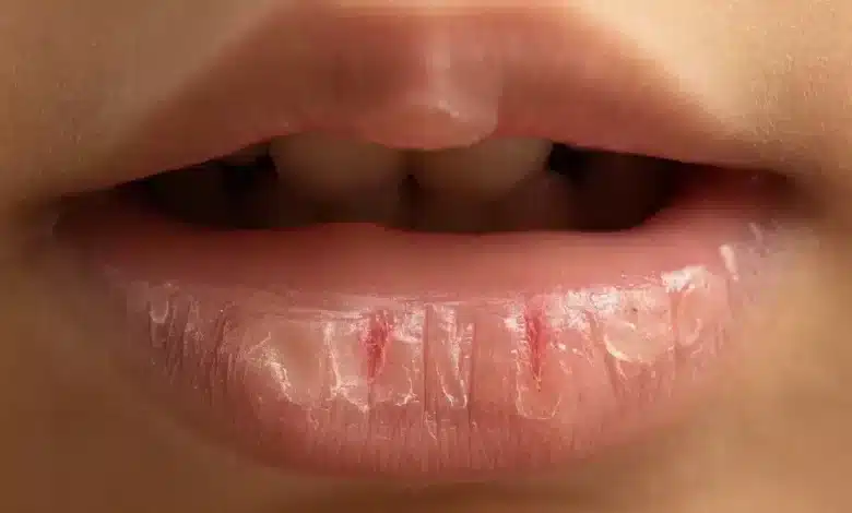 Why do lips crack in summer Know 5 reasons