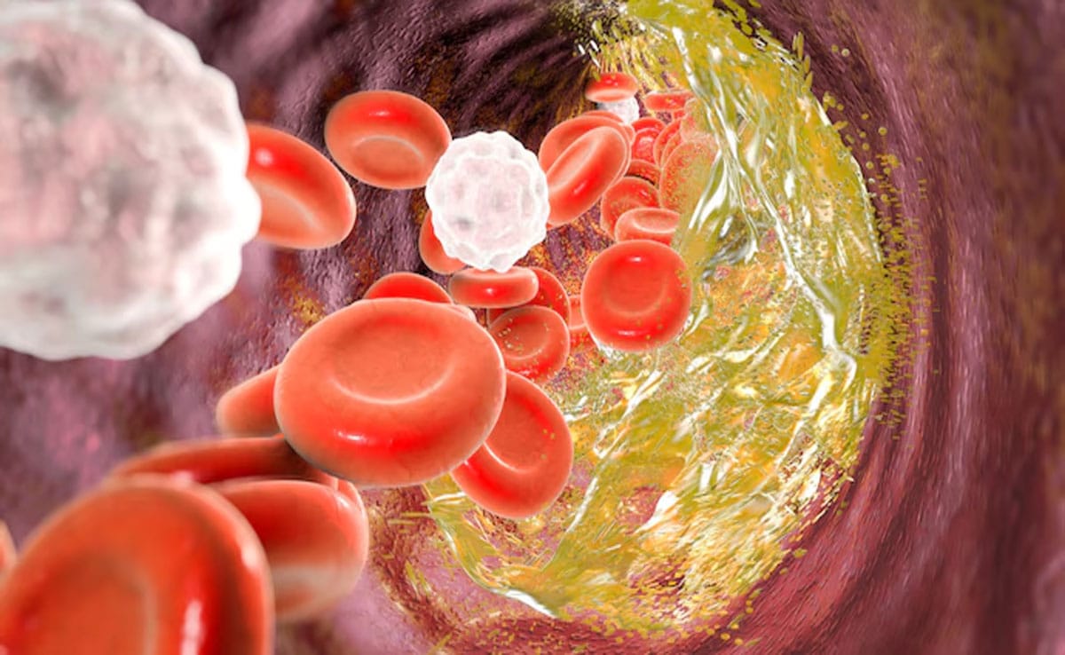 5 natural ways to get rid of bad cholesterol stuck in veins