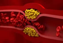 5 natural ways to get rid of bad cholesterol stuck in veins