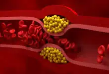 5 natural ways to get rid of bad cholesterol stuck in veins