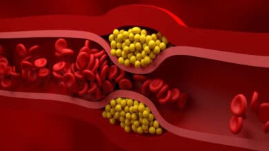 5 natural ways to get rid of bad cholesterol stuck in veins
