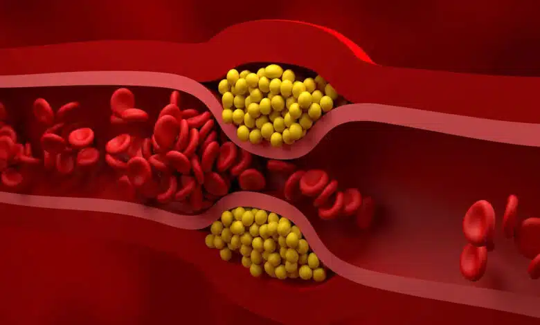 5 natural ways to get rid of bad cholesterol stuck in veins