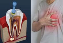 Can a root canal cause a heart attack? You should know these things