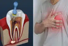Can a root canal cause a heart attack? You should know these things