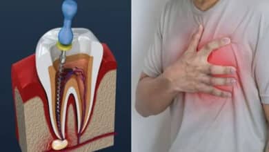 Can a root canal cause a heart attack? You should know these things