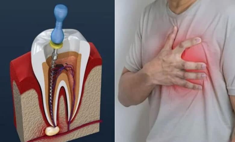 Can a root canal cause a heart attack? You should know these things