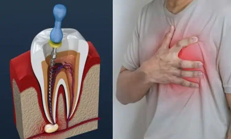Can a root canal cause a heart attack? You should know these things