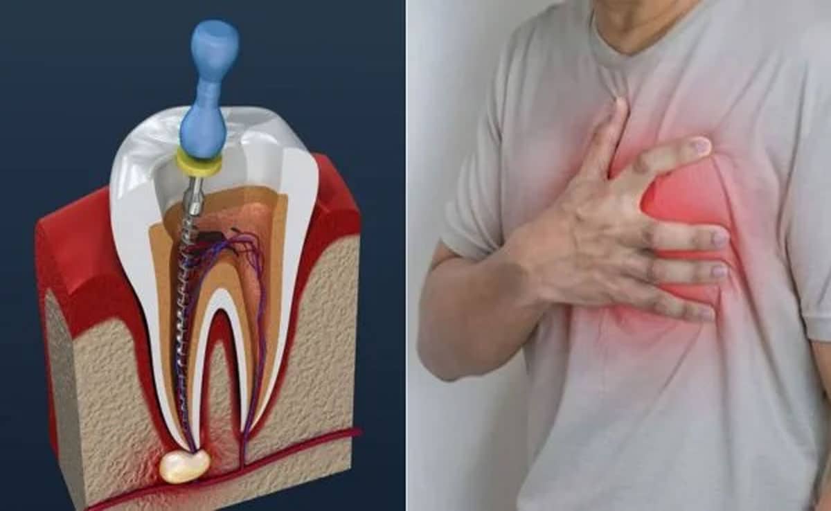 Can a root canal cause a heart attack? You should know these things