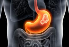 Early symptoms of stomach cancer: Identify it in time and save lives