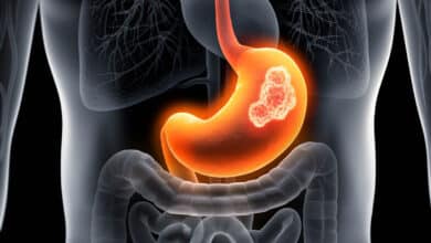 Early symptoms of stomach cancer: Identify it in time and save lives