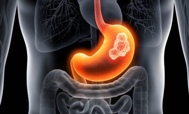 Early symptoms of stomach cancer: Identify it in time and save lives