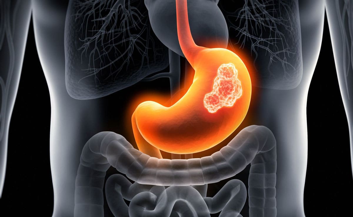 Early symptoms of stomach cancer: Identify it in time and save lives